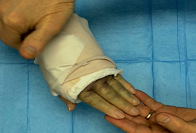 Applying passive finger extension to stretch the deep forearm flexors which will cause severe forearm flexor tenderness if a compartment syndrome is present and the flexor muscles are ischemic.