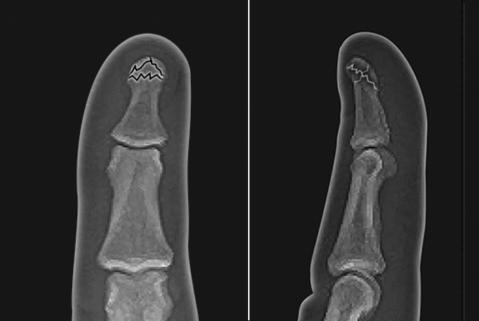 Comminuted non-displaced distal phalanx tuft fracture