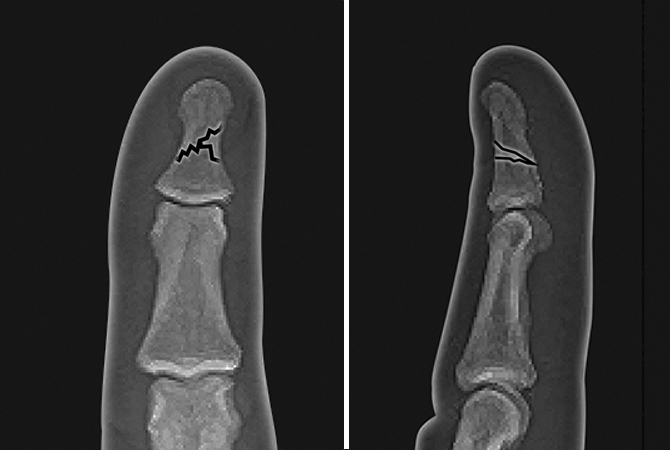 Non-displaced distal phalanx shaft fracture with small butterfly fragment