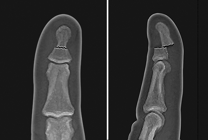 Displaced distal phalanx shaft fracture requiring reduction to re-establish support of fingernail matrix.