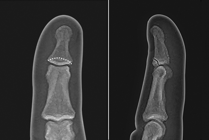 Non-displaced mallet fracture of the distal phalanx