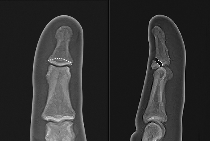 Minimally displaced mallet fracture of the distal phalanx