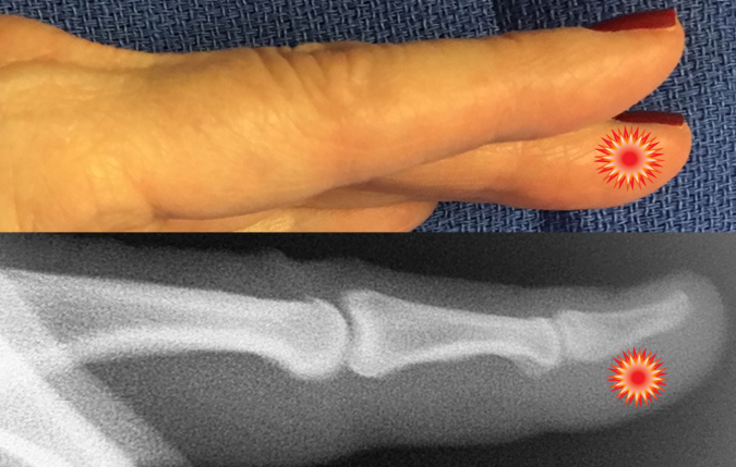 The red "tender" sign pin points the area of tenderness in relationship to the distal phalanx, DIP joint and the surface anatomy of a patient with a felon.