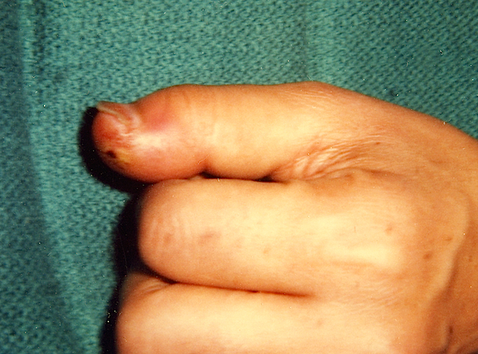 Felon Right Thumb