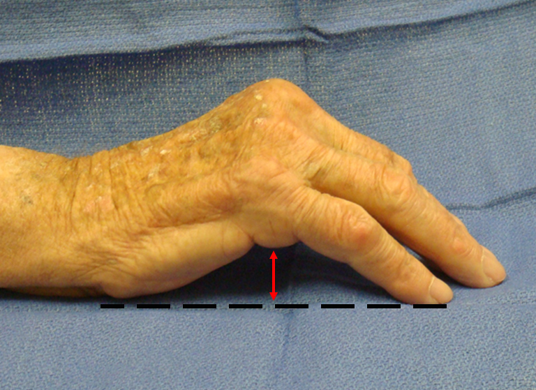 Table  Top Test - The hand can not go flat because of MP contractures caused by Dupuytren's Disease.