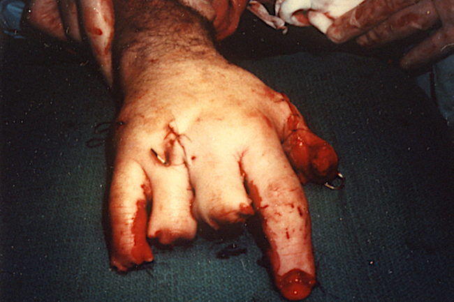 Finger amputations after revisions. Amputations secondary fireworks accident.