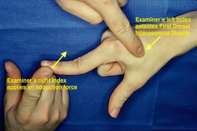 Testing the right first dorsal interosseous muscle, the last muscle innervated by the ulnar nerve.