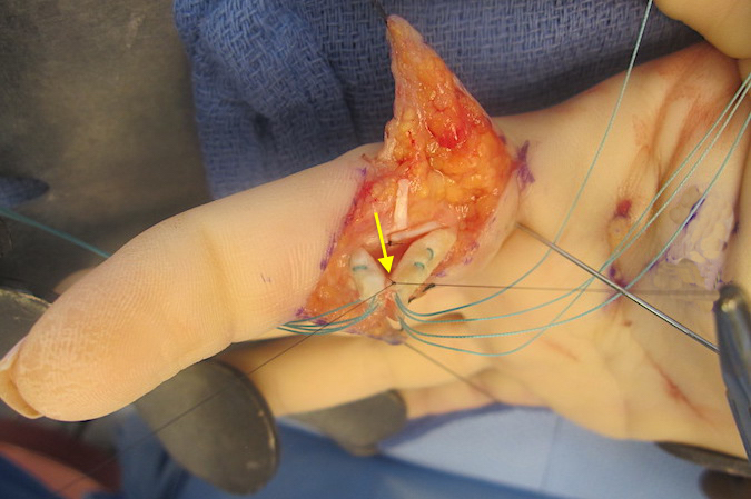 Dorsal peripheral edge suture (arrow) being placed before core sutures tied.