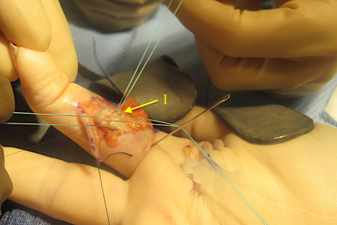 Modified Kessler core sutures being tied (1)