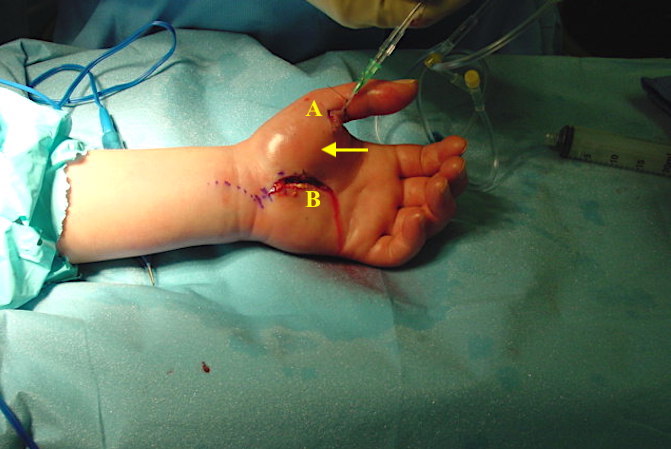 Thenar Space Infection and thumb flexor sheath surgical treatment.
