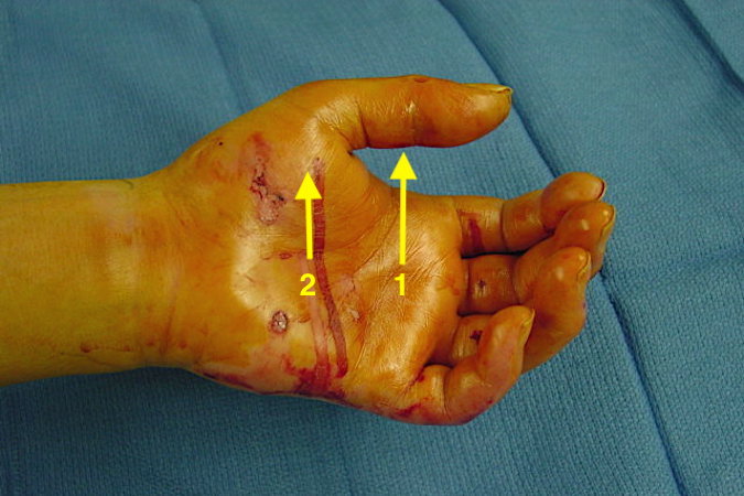 Thenar Space Infection:  Note arrow pointing to thumb flexor tendon sheath distally and second arrow at thenar space area.