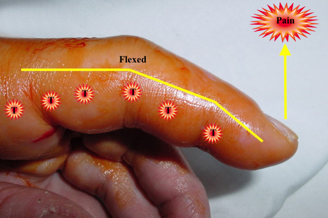 Flexor Tendon Sheath Infection with three Kanavel's Signs: tenderness along the flexor sheath, finger in a flexed position, and pain with passive extension.