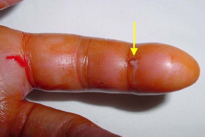 Flexor Tendon Sheath Infection with puncture wound (arrow) and the fourth Kanavel sign:swelling of the entire digit.