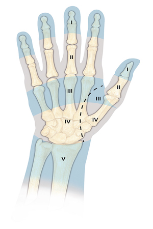 Flexor Tendon Zones of injury for fingers, thumb, hand, and wrist. The most difficult repairs are those done in Zone II where the fibro osseous tunnel of the flexor tendon sheath is narrow and tight.