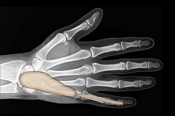 Little finger flexor tendon sheath is usually connect to the ulnar bursa.