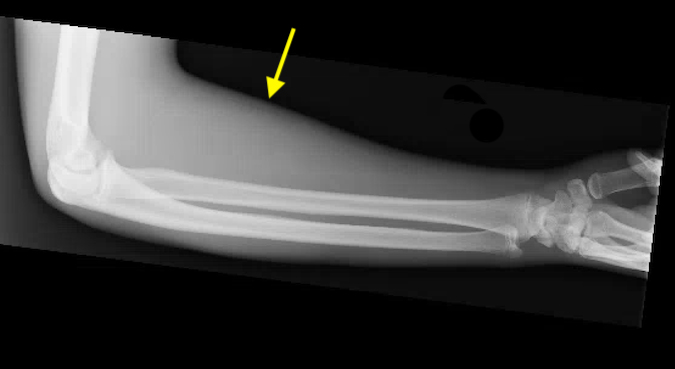 Diabetic patient presenting with swollen, tense and painful proximal forearm. Note increased thickness of soft tissue shadow (arrow) on X-ray. Blood glucose marked elevated.