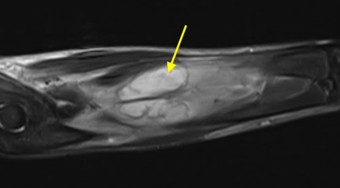 MRI consistent with abscess in proximal volar forearm with secondary compartment syndrome