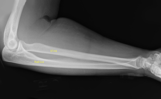Forearm Lateral View