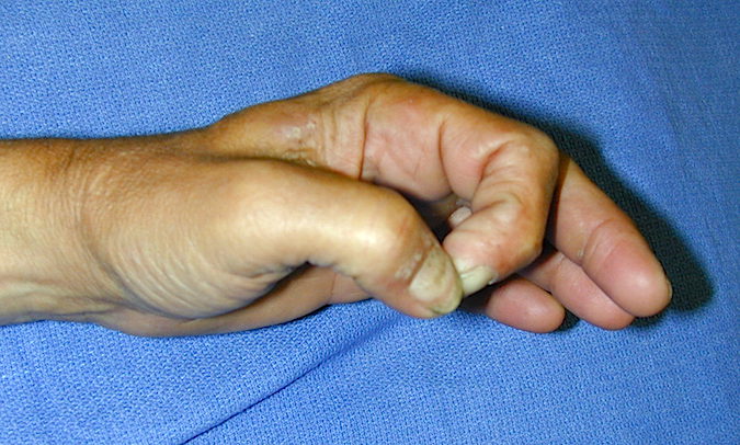 Positive Froment's sign. Patient is supporting index with the other fingers, hyperflexing the thumb IP joint and the space between the thumb and index is a rectangular space not a perfect "O".