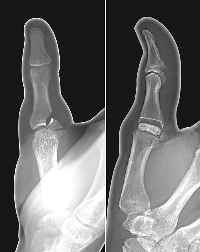 Displaced intra-articular thumb proximal phalanx base fracture (Gamekeeper's Fracture) at the ulnar collateral insertion. Note the articular surface on the fracture fragment is rotated out of the joint. This will require CRIF or ORIF.