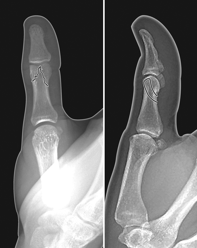 Bicondylar non-displaced intra-articular thumb proximal phalanx fracture