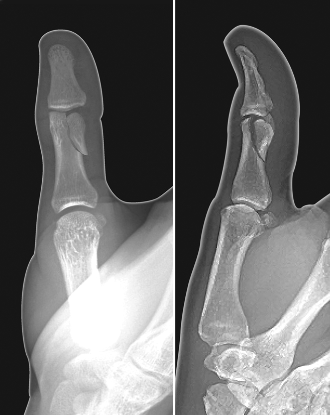 Condylar displaced intra-articular thumb proximal phalanx fracture