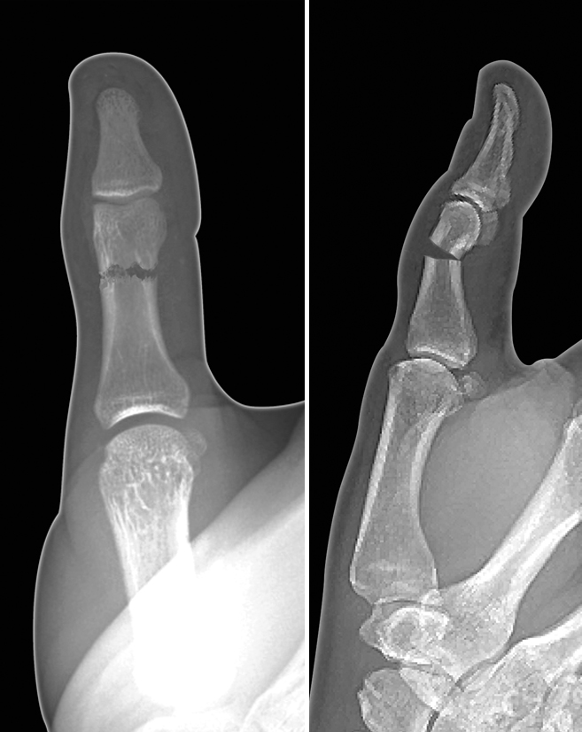 Thumb angulated proximal phalanx shaft fracture
