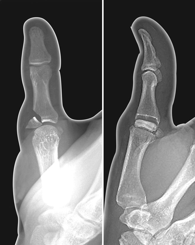 Displaced intra-articular thumb proximal phalanx base fracture at the radial collateral insertion. Note the articular surface on the fracture fragment is rotated out of the joint. This will require CRIF or ORIF.