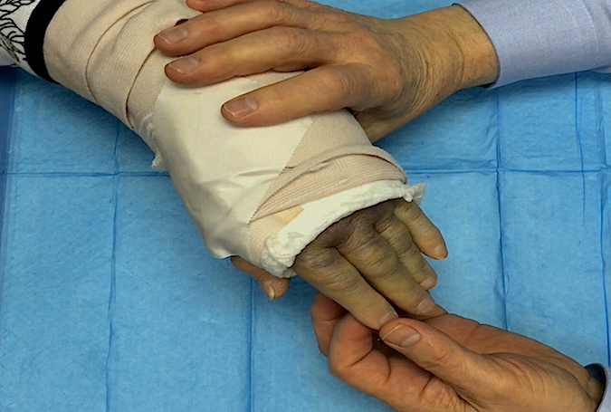Checking finger sensation in recently reduced and splinted Colle's fracture patient.