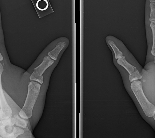 Thumb proximal phalanx angulated base fracture AP and oblique views