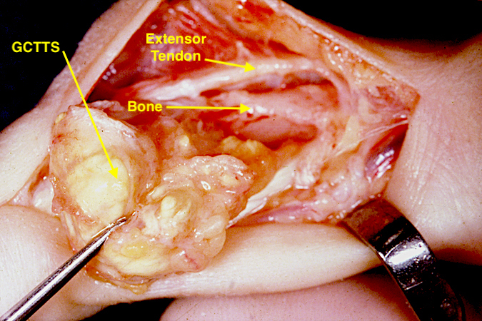 Large chronic GCTTS compressing and flattening the middle phalanx (bone).