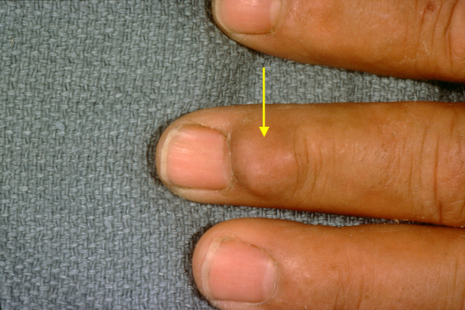 GCTTS (arrow) left long finger masquerading as a mucoid cyst.