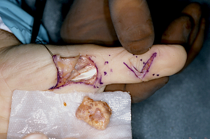 GCTTS recurrent at two levels left thumb.
