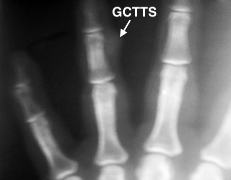 GCTTS left ring finger AP X-ray. GCTTS over middle phalanx (arrow)