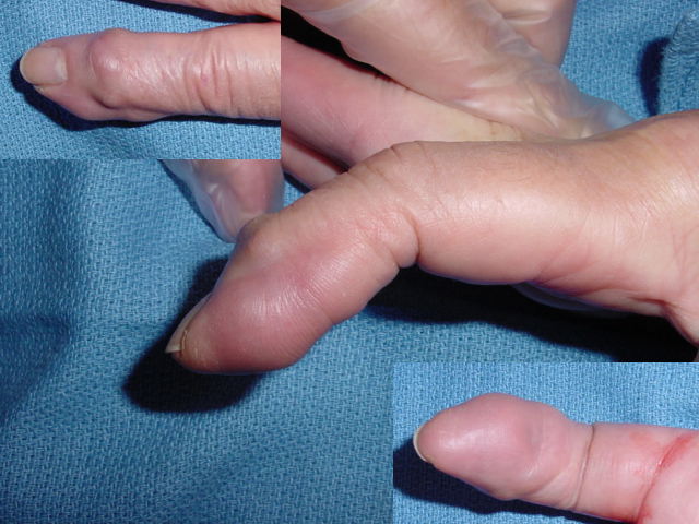 GCTTS right index DIP area with dorsal, side and palmar views