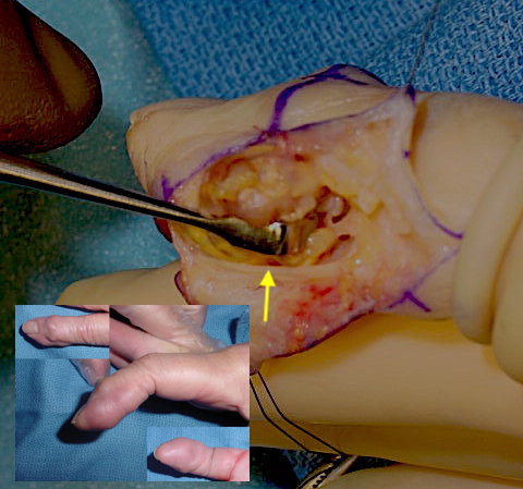 GCTTS right index finger DIP joint. Note digital nerve (arrow) and tumor behind retractor has destroyed the collateral ligament and is entering the DIP joint.