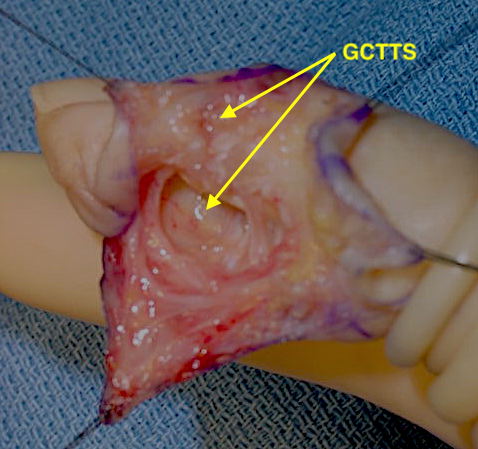 GCTTS right index finger DIP joint involving volar and dorsal parts of the DIP joint.
