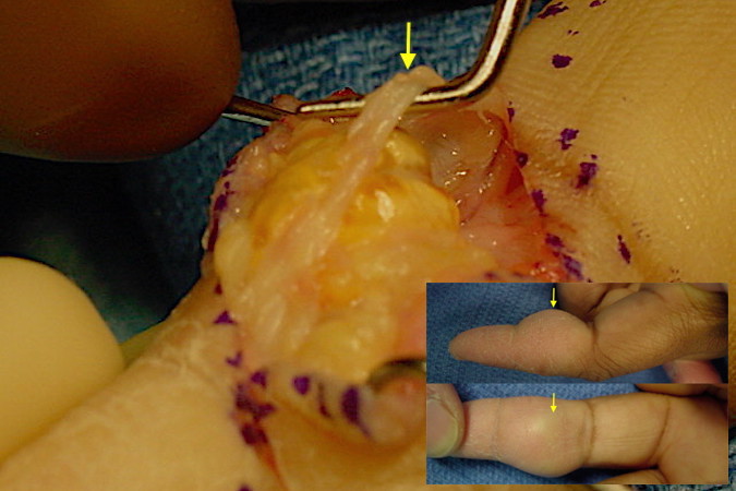 GCTTS right index finger over middle phalanx. Note digital nerve superficial to the tumor.