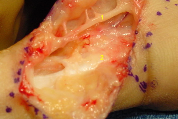 GCTTS right index finger over middle phalanx has been excised.  1 - digital nerve ; 2 - flexor tendon sheath.