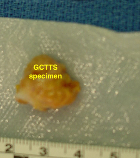 GCTTS right index finger over middle phalanx specimen.