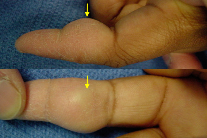 GCTTS right index finger over middle phalanx - two views
