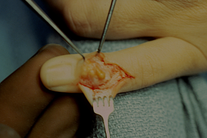 GCTTS dorsal DIP joint left fifth finger with skin involvement.