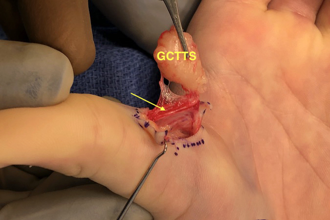 GCTTS right thumb almost completely excised. Note ulnar digital nerve (arrow).