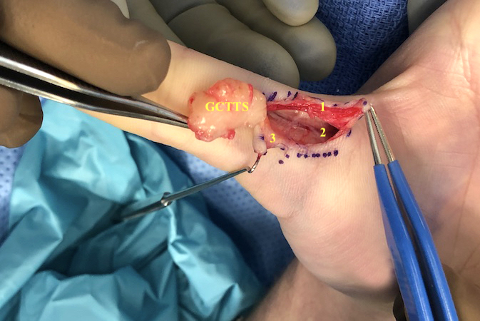 GCTTS right thumb excised.  1 - digital nerve; 2 - digital artery; 3 - FPL flexor tendon sheath.