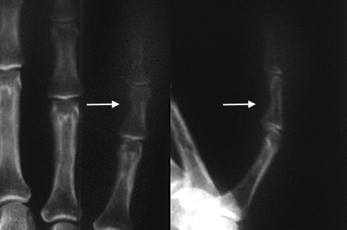 GCTTS left little finger AP and Lateral X-rays. GCTTS over middle phalanx (arrow)