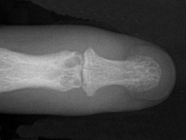 AP X-ray of moderate gout of DIP joint. Note erosions (asymmetric punched-out defects)