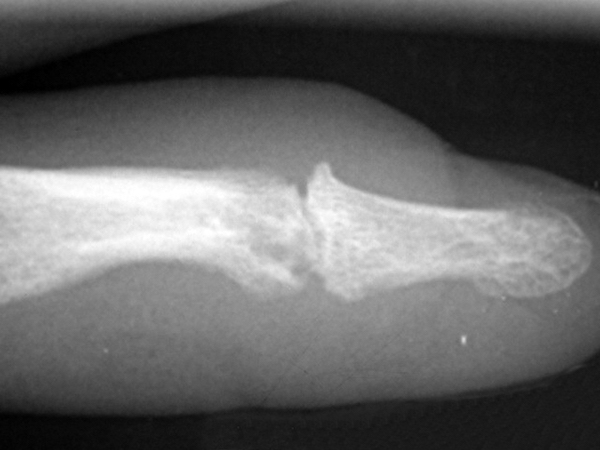 Lateral X-ray of moderate gout of DIP joint. Note erosions (asymmetric punched-out defects)