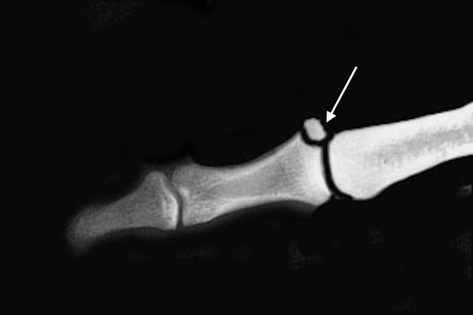 Thumb intraarticular ulnar collateral avulsion fracture, Gamekeeper's FX, site (arrow).