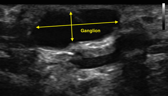 Ultrasound showing an anechoic ganglion of the wrist