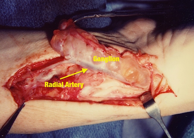 Volar Ganglion being dissected off radial artery